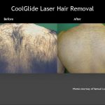 Hair Removal Back