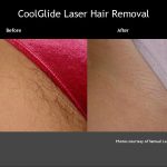 Hair Removal Bikini