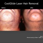 Hair Removal Chin