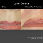 Laser Genesis Perioral Cavity