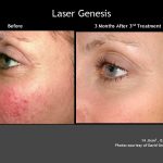 Before & After Photo of Laser Genesis Treatment of Rosacea