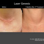 Before & After Photo of Laser Genesis Scar Treatment