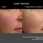 Laser GenesisWrinkles & Texture
