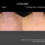 Limelight IPL Chest