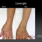 Before & After Photo of Limelight IPL Skin Treatment of Hand