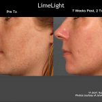Before & After Photo of Limelight IPL Fotofacial Treatment